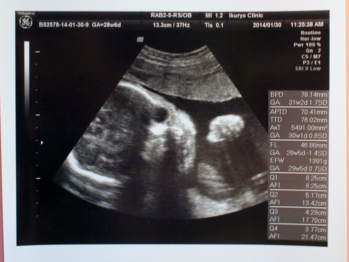 胎児のエコー写真（妊娠28週）