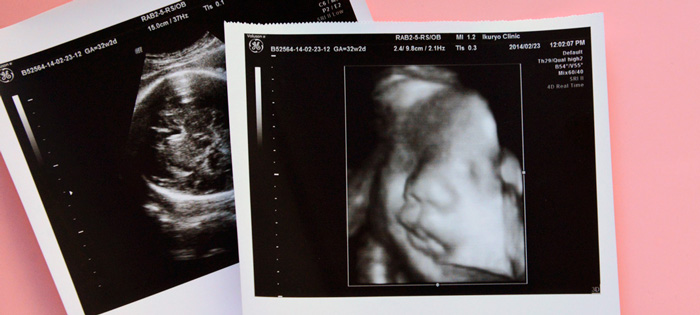 赤ちゃんエコー写真 32週 9ヶ月目
