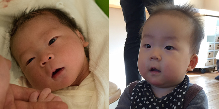 （左）生後30分（右）生後11ヶ月