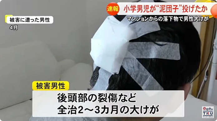 泥団子で怪我をさせられた男性の後頭部